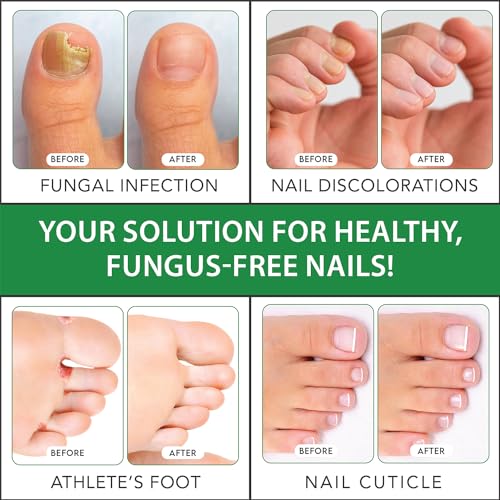 Viking Revolution Toenail Fungus Treatment Extra Strength with 1% Tolnaftate OTC Viking Revolution